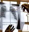 Major funders back pivotal trial of novel TB vaccine