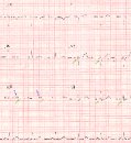 Cureus paper by dean and medical student retracted for mislabeled ECG