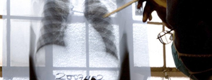 Major funders back pivotal trial of novel TB vaccine