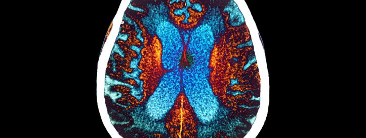 Study Suggests Alzheimer's Transmission through Historic Hormone Treatment