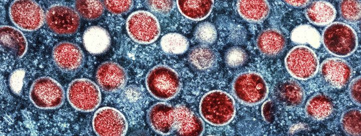 Rattled by mpox surge in Africa, WHO declares a global health emergency—again