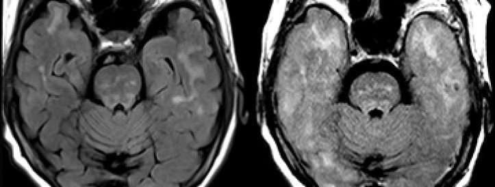 Preprint on Alzheimer’s drug deaths ignites dispute among authors