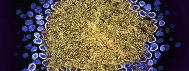 Seventh patient ‘cured’ of HIV: why scientists are excited